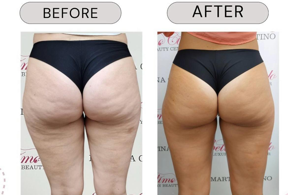 T-shape2 Uygulama Öncesi Sonrası