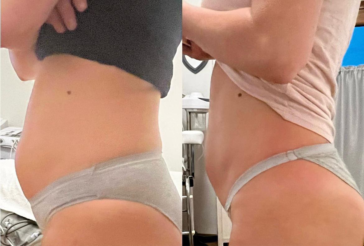 T-shape2 Uygulama Öncesi Sonrası