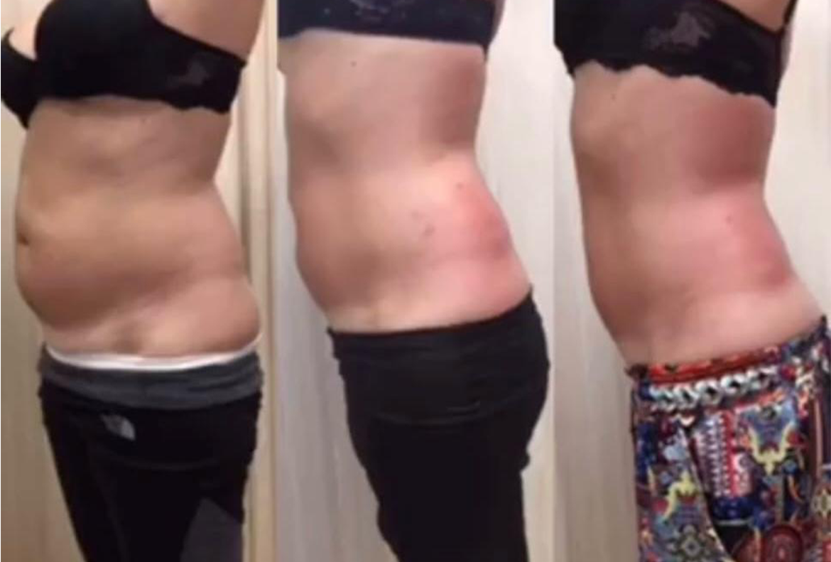 T-shape2 Uygulama Öncesi Sonrası