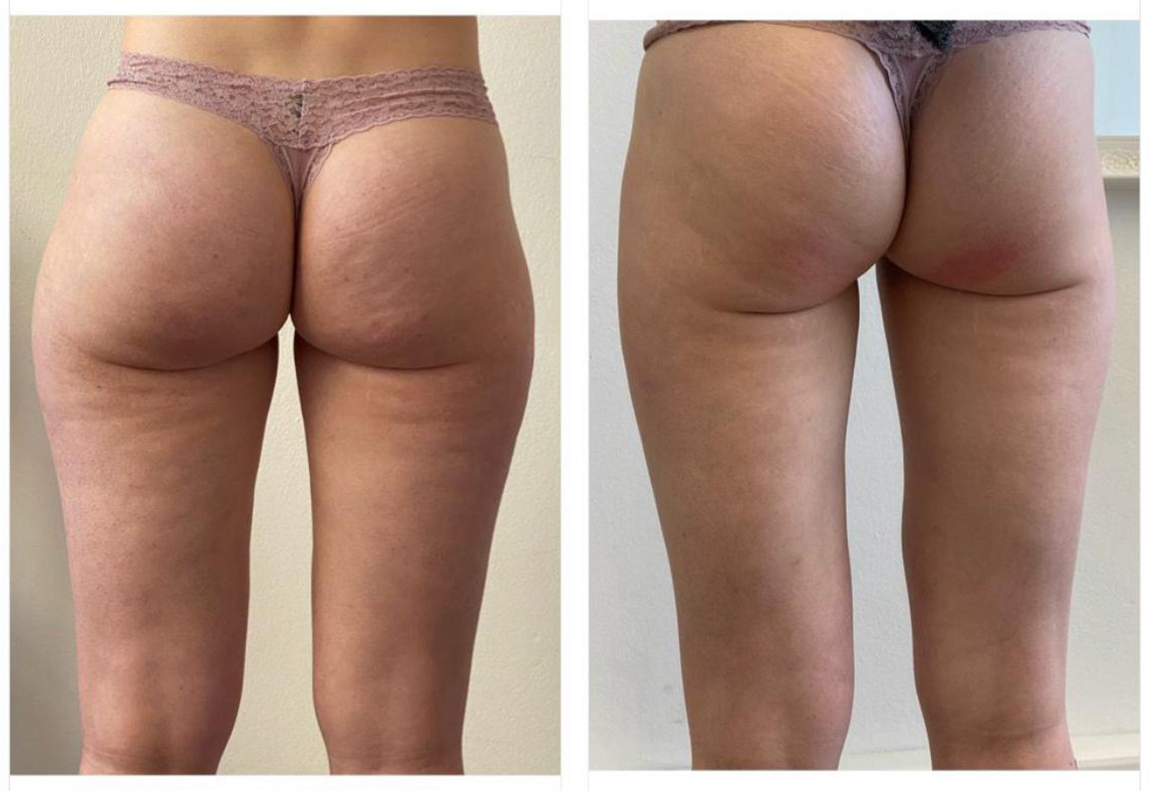 T-shape2 Uygulama Öncesi Sonrası
