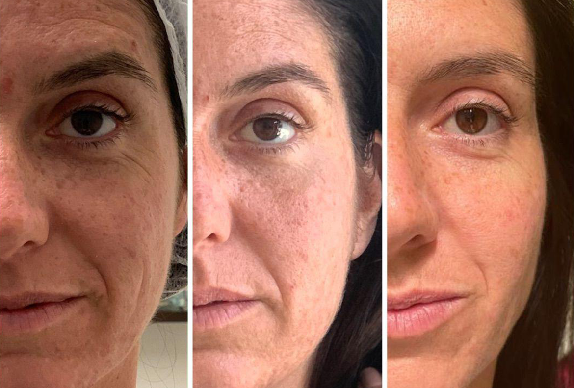 T-shape2 Uygulama Öncesi Sonrası