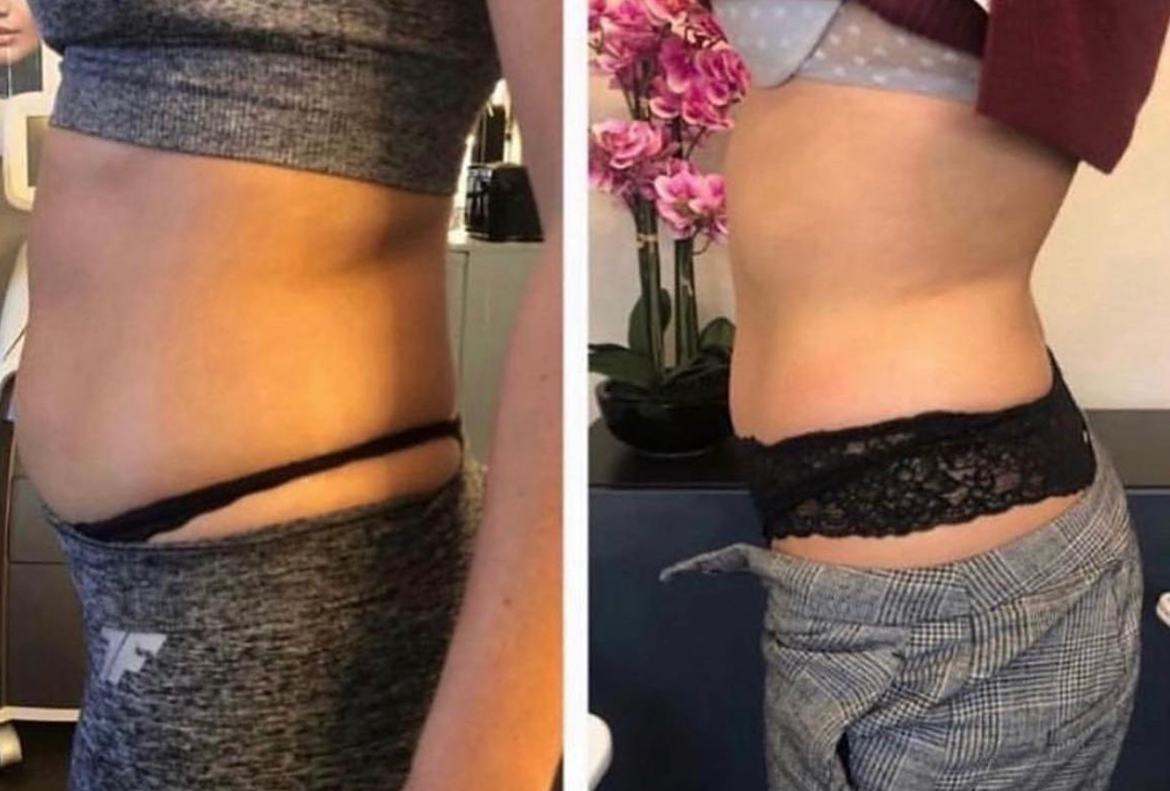 T-shape2 Uygulama Öncesi Sonrası
